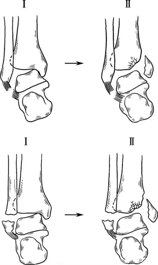 骨折闭合复位髓内钉内固定术,骨折闭合复位