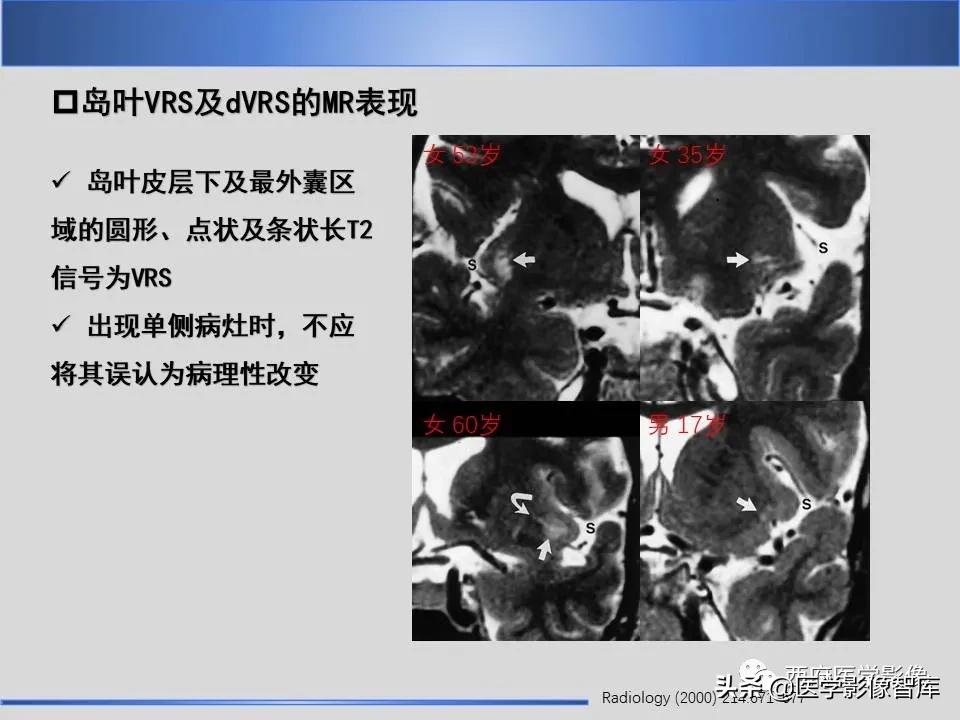 vr间隙概念,vr间隙需要做什么检查