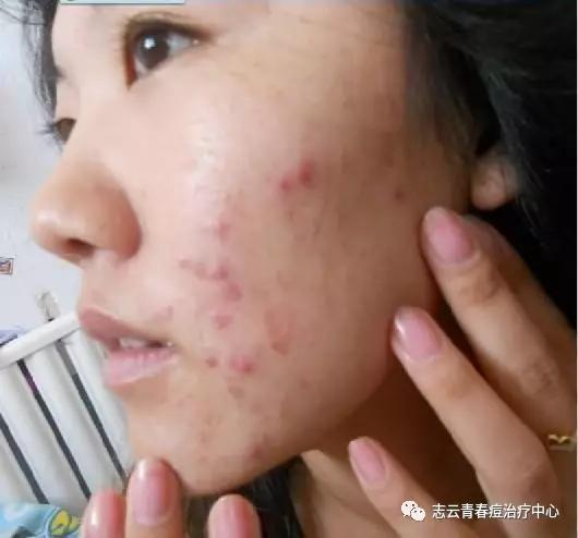 脸上长痘痘如何不用任何产品消除,女生脸上长痘痘怎么调理排毒祛痘