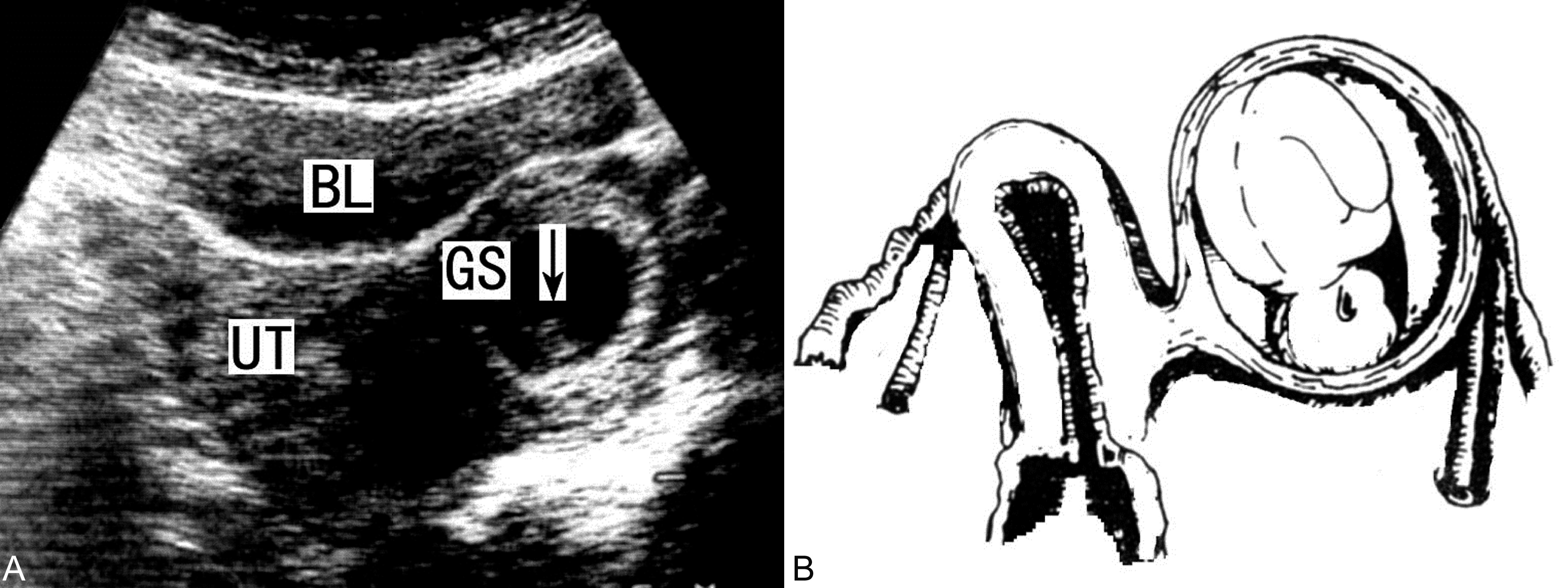 明明白白做产检,残角子宫妊娠超声表现