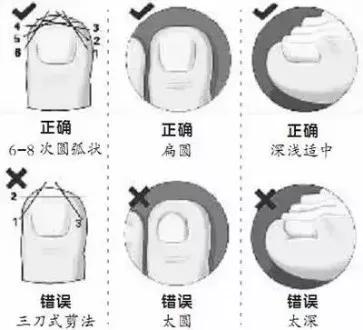 跑步后脚趾甲充血变黑怎么办,跑步为什么有黑指甲