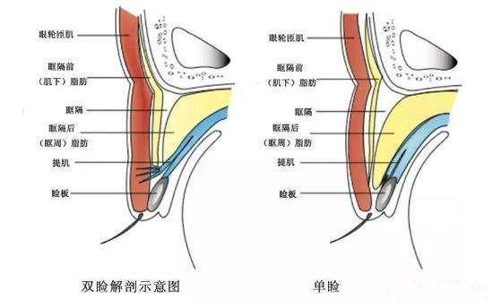 双眼皮、眼整形的误区，眼睛手术的坑，不要往里面跳了