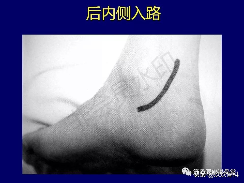 距骨骨折后遗症,距骨骨折怎么办