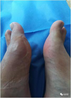 中医治疗痛风的有效方法,中医治疗痛风的思路是什么