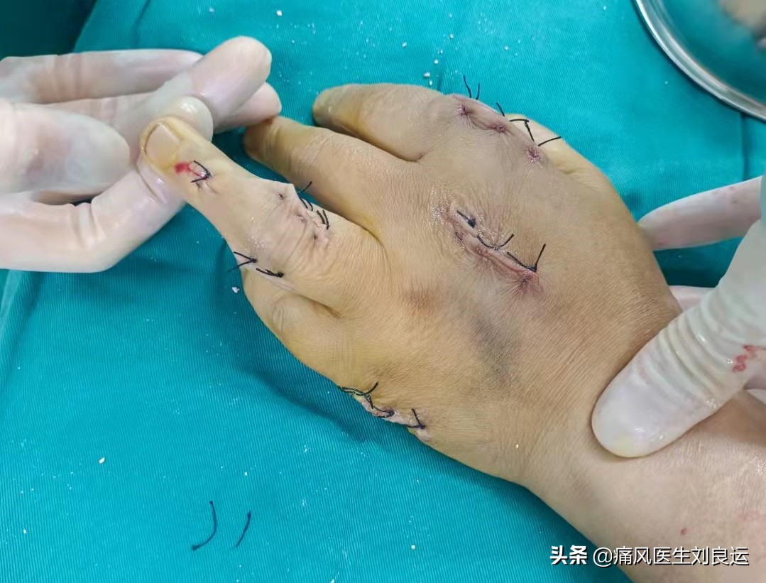 痛风富贵病,饮食很清淡但犯痛风了