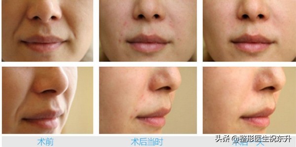 自体脂肪填充法令纹亲身经历,法令纹是不是出现了才能填充