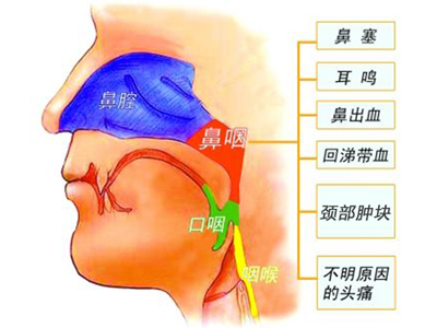 鼻咽癌最佳护理方法,鼻咽癌的预后与护理要点