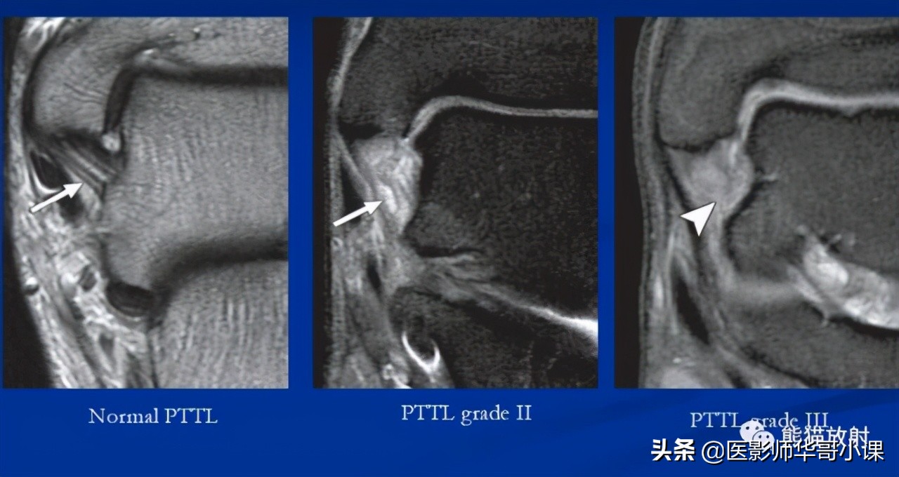 踝关节解剖视频课,解剖学韧带分布图