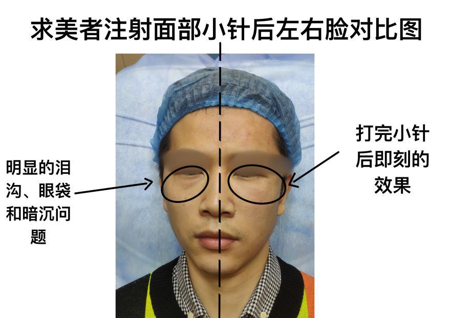 眼袋泪沟怎么消除学生,眼袋泪沟怎么消除视频教程