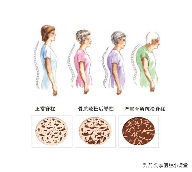 骨质疏松打一年一次的针能止疼吗,老年人骨质疏松最快的恢复办法