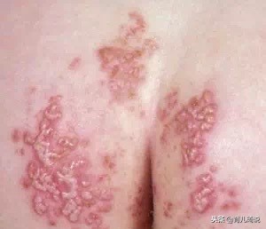 宝宝红屁股疼的直哭怎么办,宝宝红屁股的最佳治疗方法