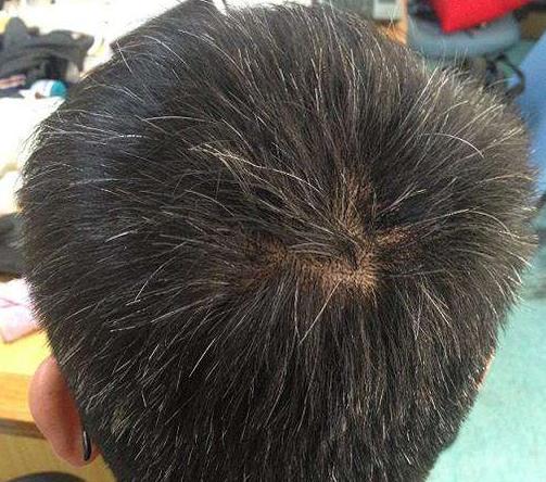 教你一招解决白发,青少年白发怎么改善