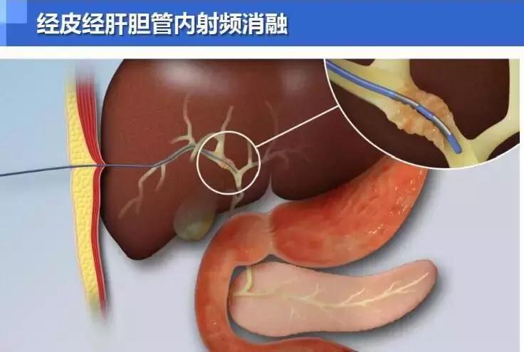 胆管下段良性肿瘤手术治疗方法,恶性肿瘤小肠梗阻介入治疗