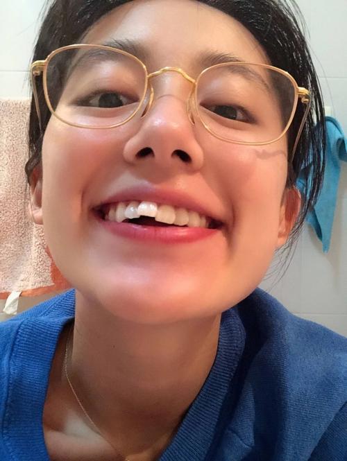 吴宣仪做牙齿前后对比,吴宣仪做整牙