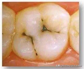 宝宝牙齿上有黑色的污垢怎么去除,婴儿牙齿有污垢怎么清理