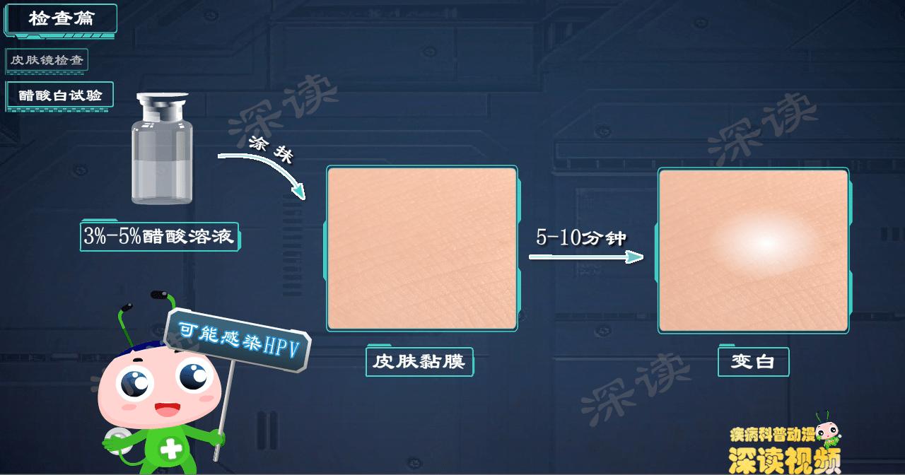 液氮冷冻治疗尖锐湿疣,冷冻和激光治疗尖锐湿疣的效果