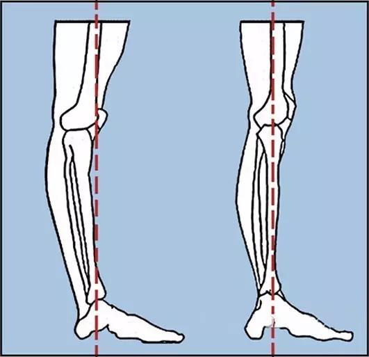 怎么改善腿型显腿长,不良体态显腿短怎么改善