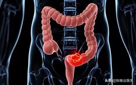 如何诊断大肠癌,大肠癌最佳检查方法