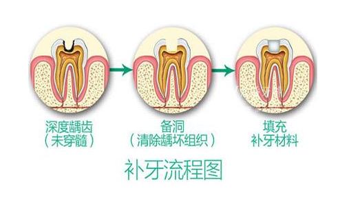 牙齿有黑线就证明里面坏了吗,牙齿有黑渍一定是龋齿吗