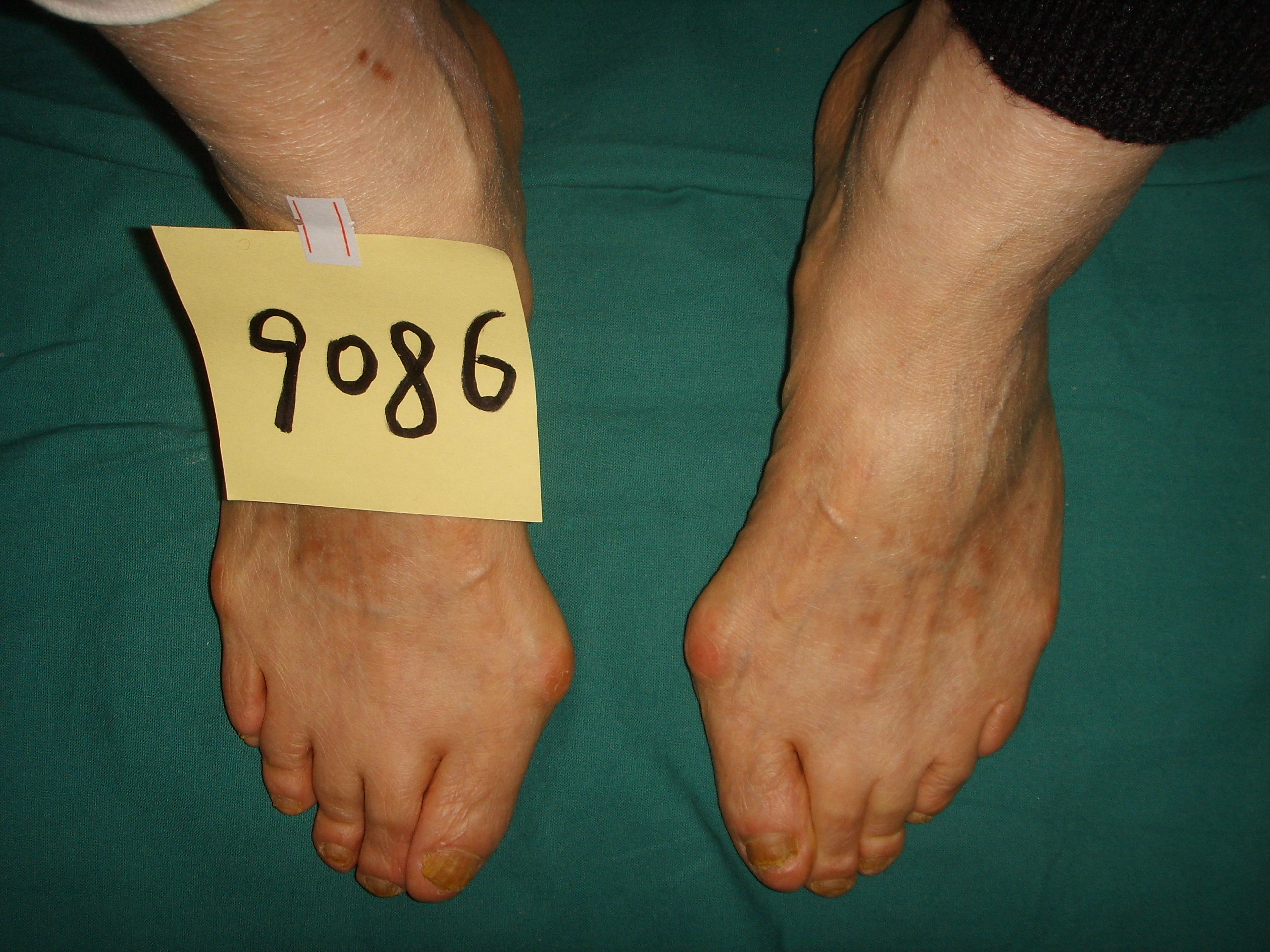 广东河源58岁大姐大脚骨，前足足横弓塌陷，脚很宽怎么办