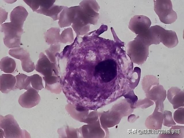 可怕的基因代谢病，一年奶粉钱足以吞噬一套房