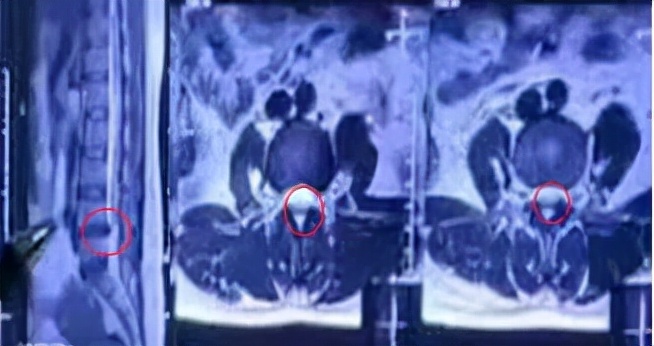 腰椎曲度变直椎体边缘变尖怎么办,腰椎曲度变直并且骨质增生怎么办