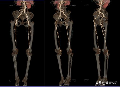 cta和血管造影怎么选择,血管oct检查与血管造影检查的区别