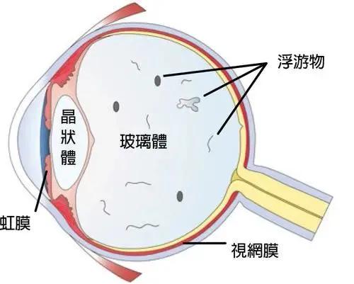 巩膜加固为什么能防止视网膜脱落,后巩膜加固术近视度数降低