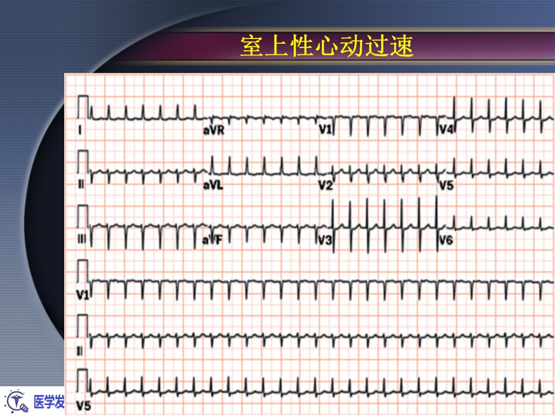 麻醉手术常见心律失常处理,麻醉引起心脏骤停原因