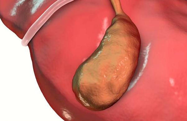 胆囊长息肉怎么治,胆囊上有息肉应该怎么治疗