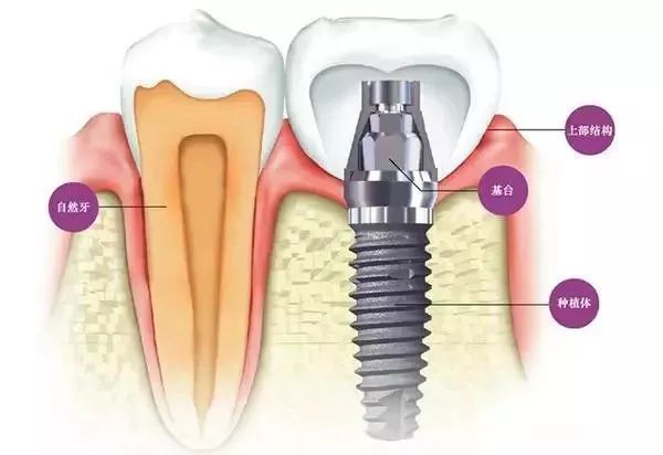 不缺牙牙槽骨吸收怎么补救,牙齿松动牙槽骨吸收最佳补救方法