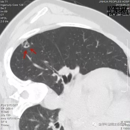 警惕-会是简单的肺大泡吗？