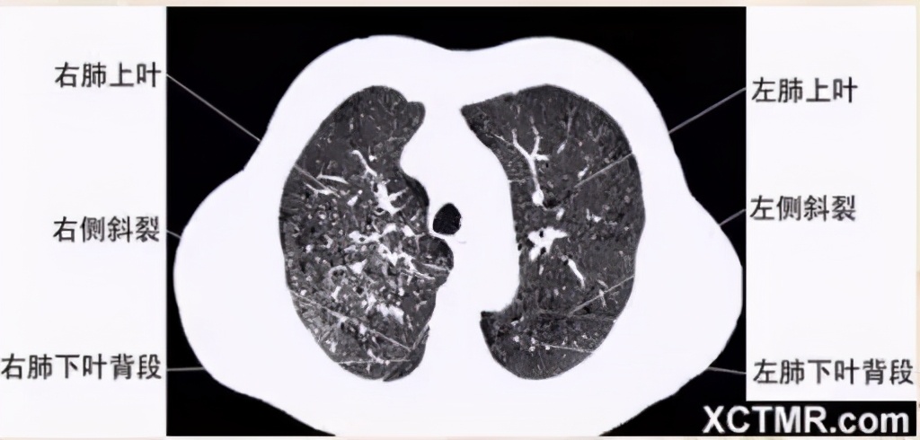 女性盆腔ct断层解剖结构图,女性盆腔脏器ct解剖
