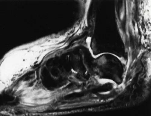 神经性骨关节病,神经性关节炎症状图片