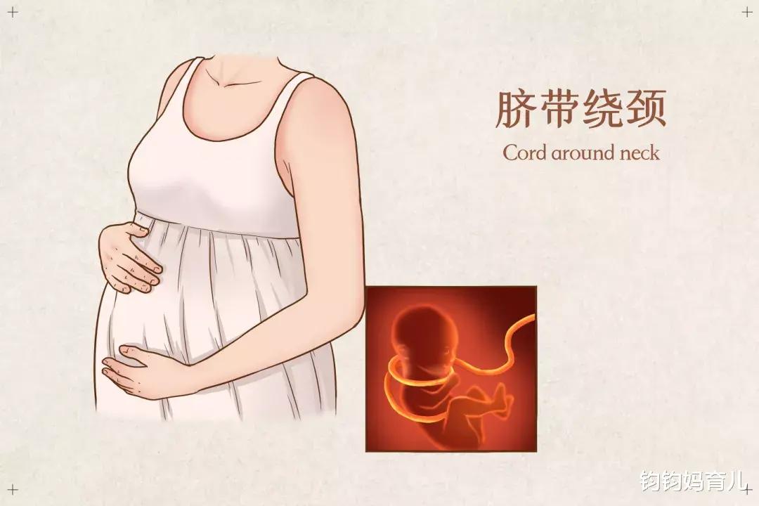 宝宝脐带绕颈怎么办,脐带绕颈的孩子命运