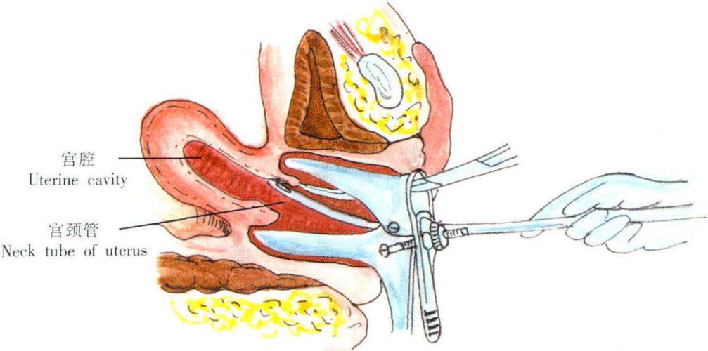 大姨妈来十几天有必要做诊刮吗,不把大姨妈当回事语录