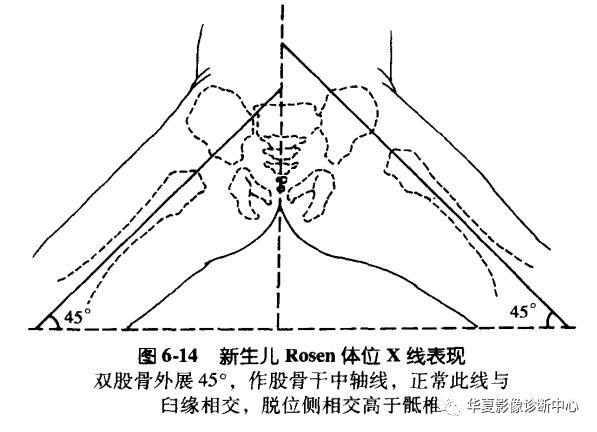先天性髋关节脱位截骨术全过程,先天性髋关节脱位可以考驾驶证吗