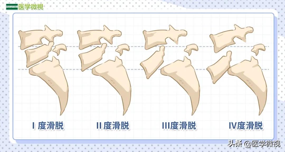 腰椎滑脱与腰椎间盘突出,腰椎间盘突出牵拉会不会造成滑脱