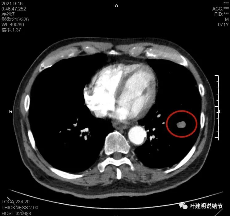 肺上有实性结节6mmx5mm是什么原因,肺上有1.7x1.8的实性结节该怎么办