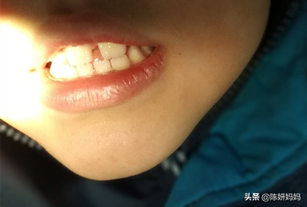 蛀牙都是吃糖惹的祸?别冤枉孩子了,牙医告诉你实情!