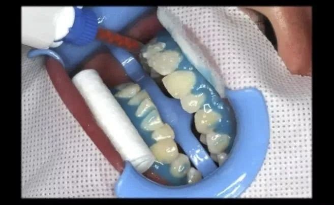 牙齿总是黄黄的?唯美口腔教你2个靠谱方法美白牙齿