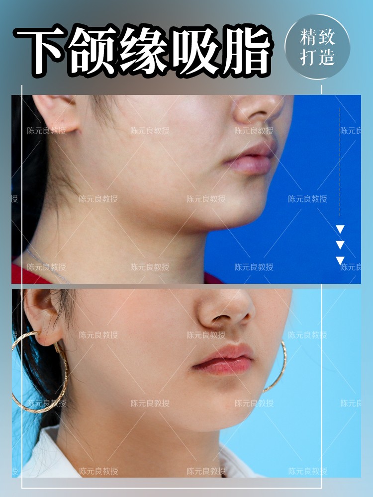 面部吸脂的真相,面部吸脂和双身体吸脂区别