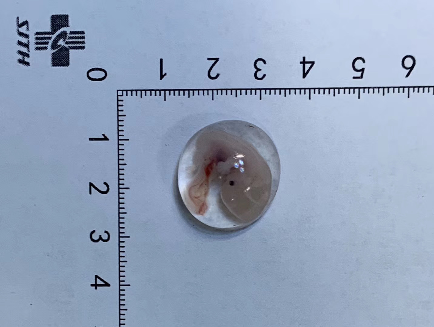 月经淋漓不尽突然大出血啥原因,月经淋漓不尽还腹痛腹胀是什么病