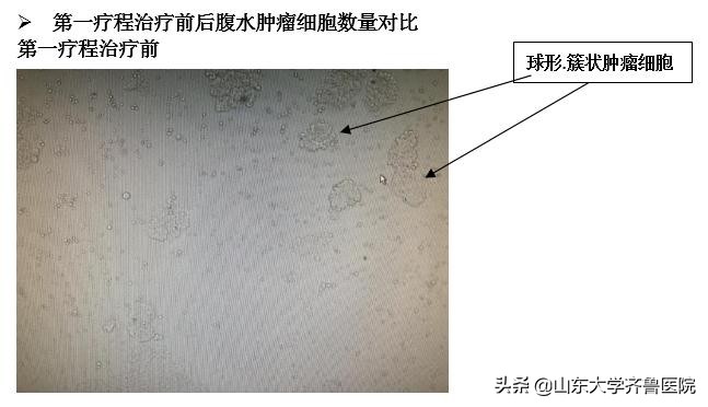 中国首创载药囊泡治疗,山东齐鲁医院自己研制的药