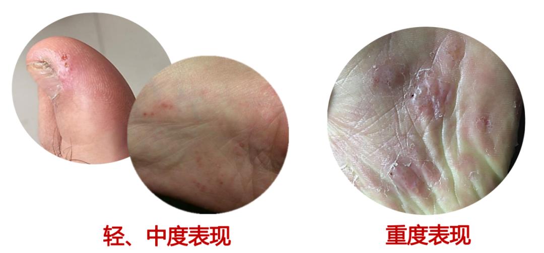 家里治脚气最好的方法,家庭治脚气的最好方法