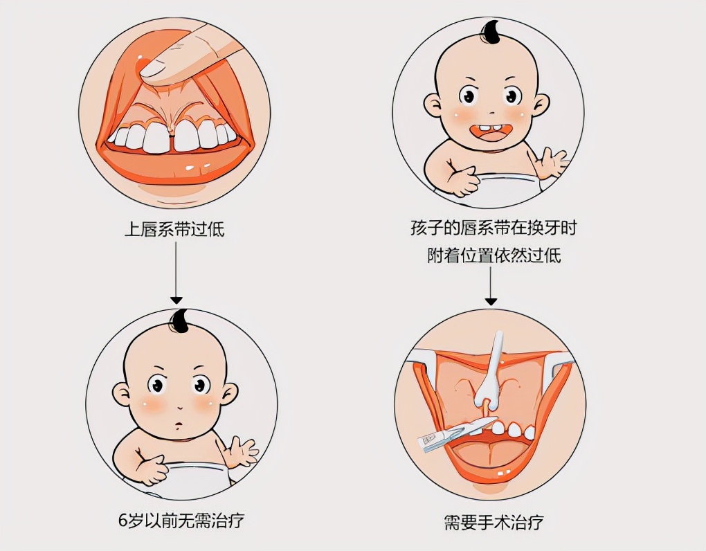 门牙中间为什么有缝,门牙中间有缝预示什么