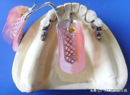 假牙哪种材料戴起来舒服,假牙挑选