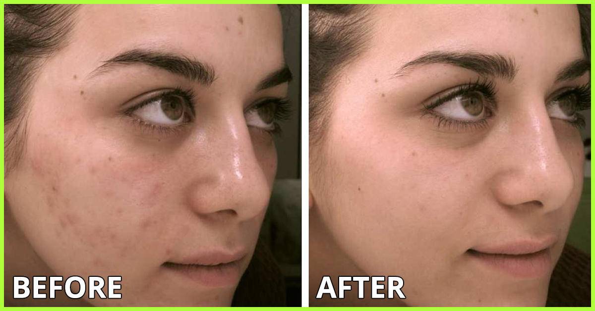 祛痘印用什么精油比较好,祛痘印精油在什么步骤用