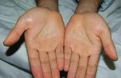 人无汗，心不安！出汗部位可以看健康状况，这几处常出汗要重视