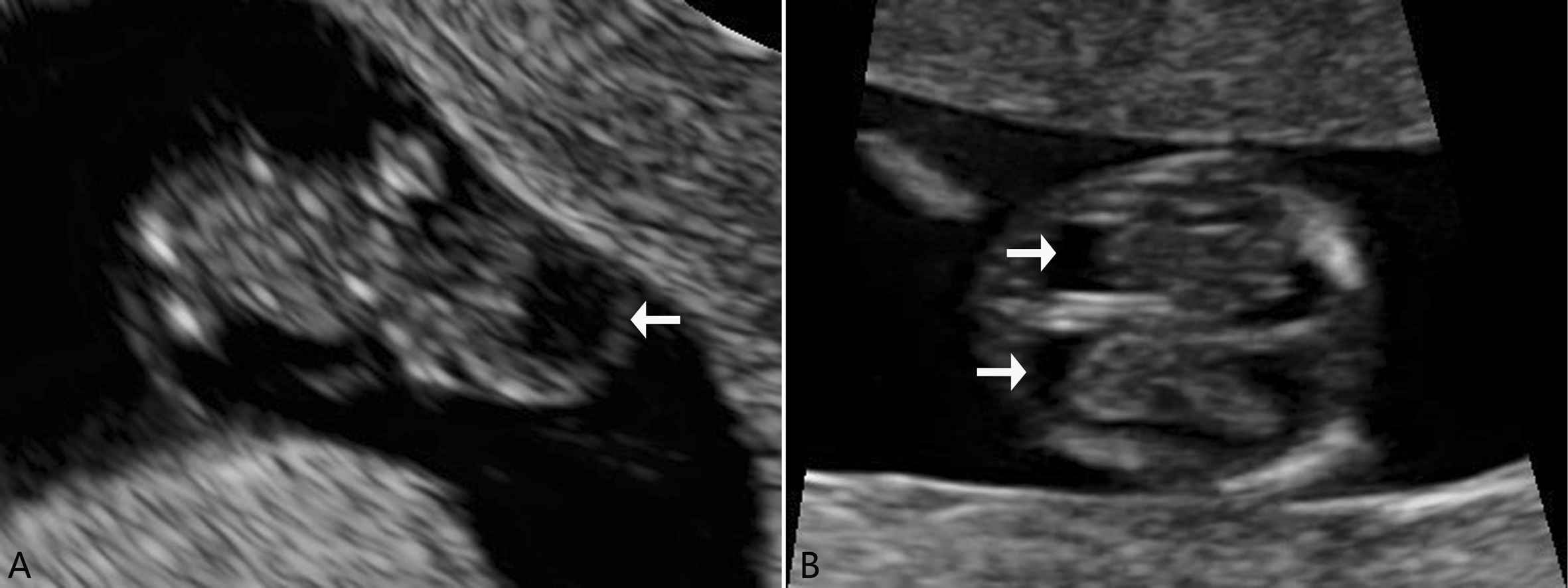 胎儿神经系统发育异常的超声表现,胎儿中枢神经系统超声检查视频